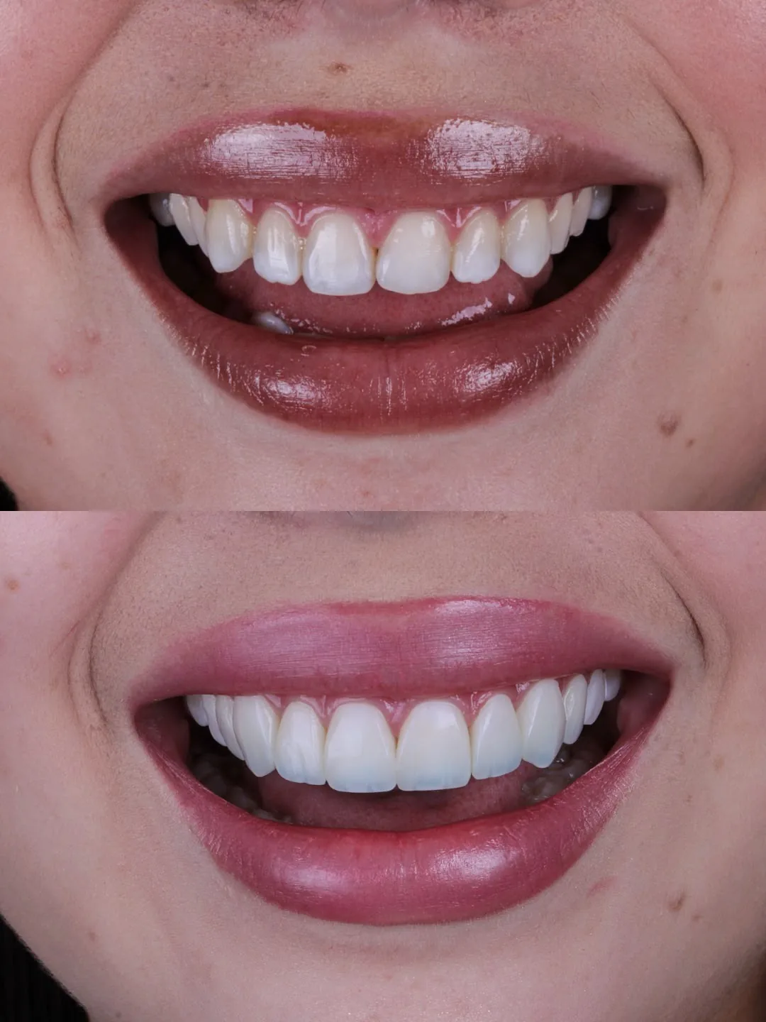 Sorriso natural após lentes de resina
