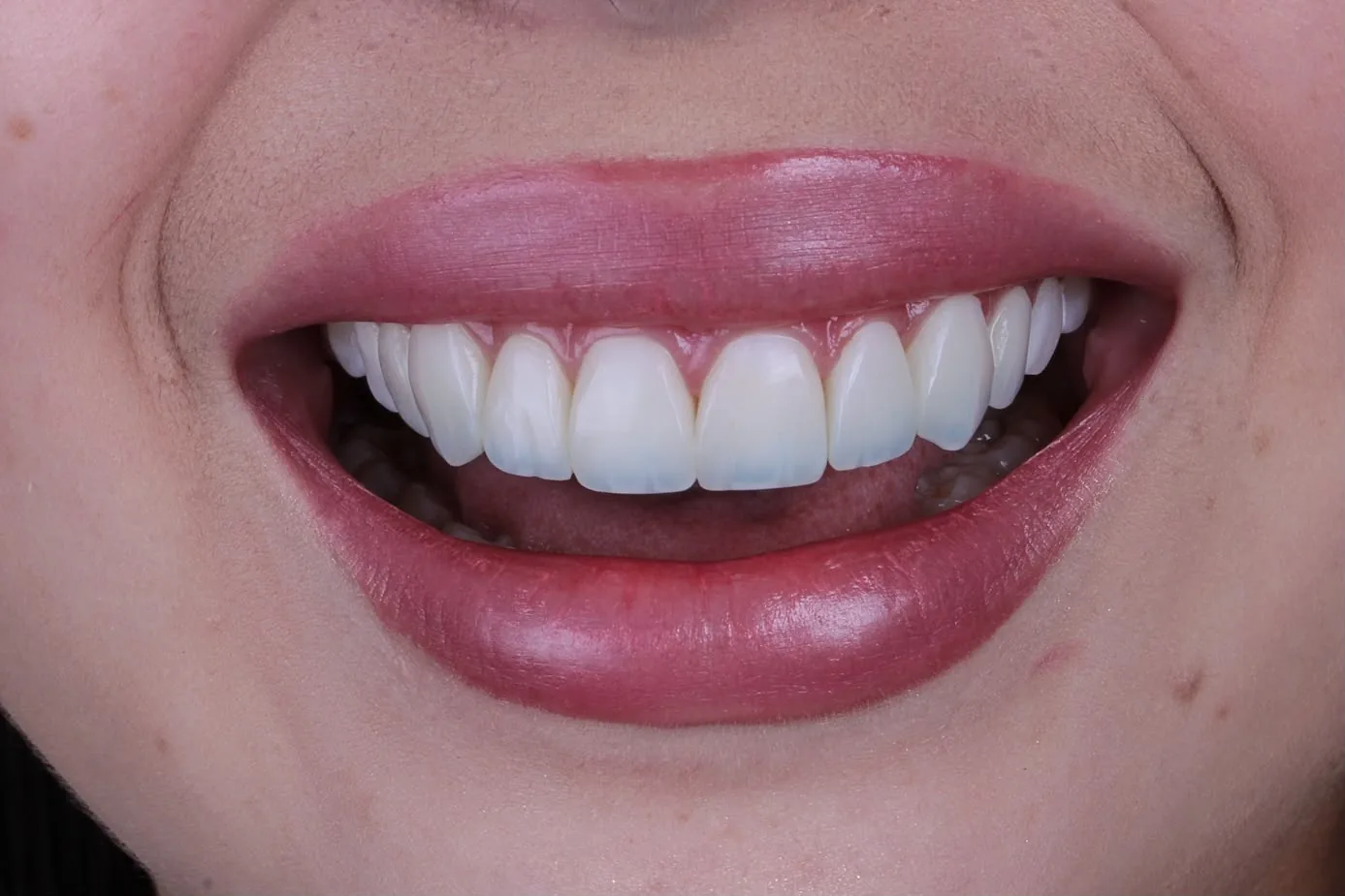 Antes e depois de sorriso com dentes desgastados tratados com lentes de resina