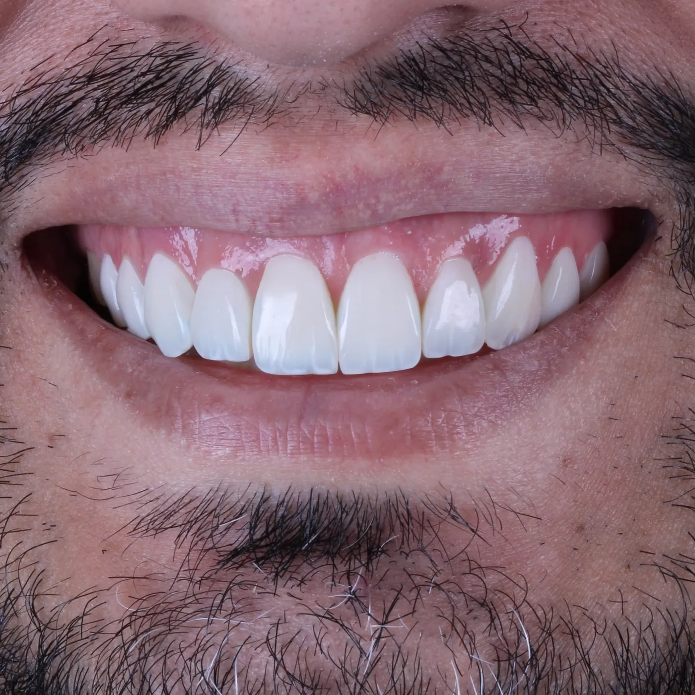 Sorriso próximo após lentes de resina