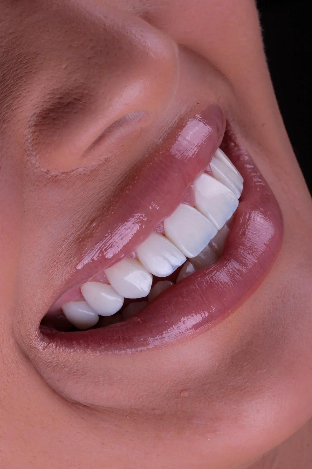 Detalhe próximo de dentes com lentes de resina