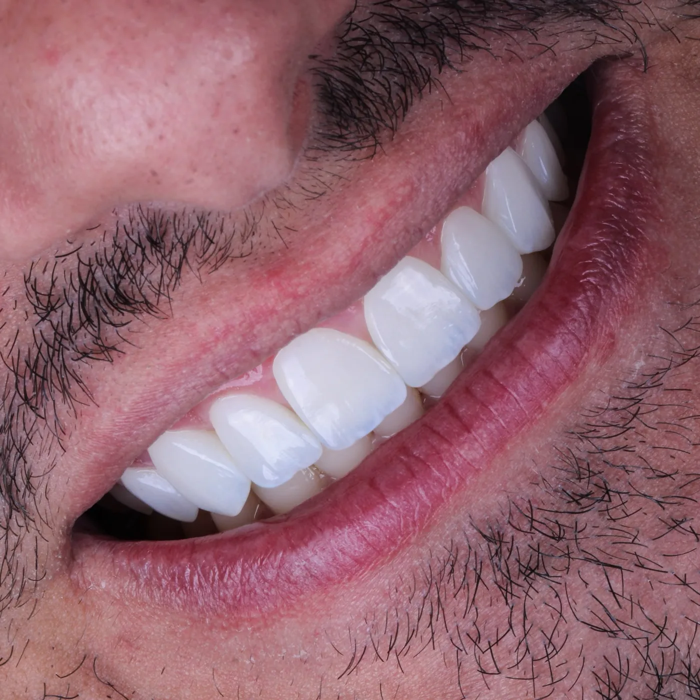 Antes e depois de sorriso com diastema tratado com lentes de resina